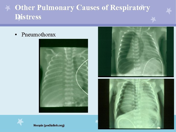 Other Pulmonary Causes of Respiratory Distress • Pneumothorax Neopix (pedialink. org) 