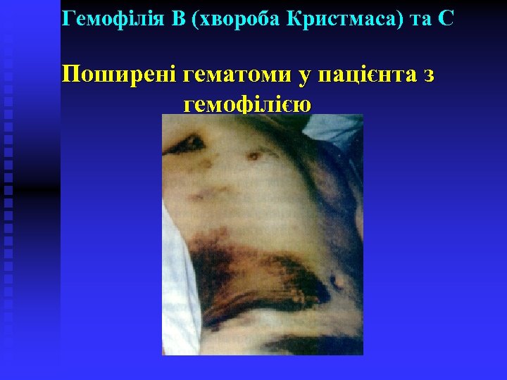 Гемофілія В (хвороба Кристмаса) та С Поширені гематоми у пацієнта з гемофілією 