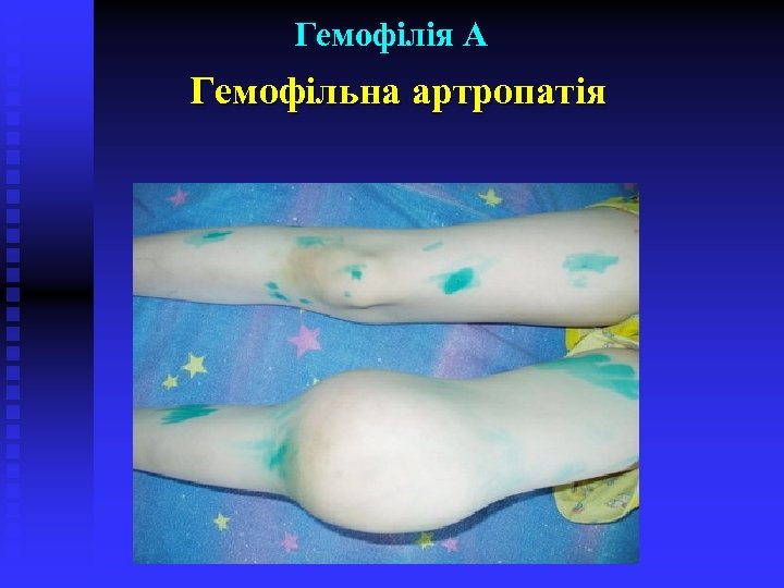 Гемофілія А Гемофільна артропатія 