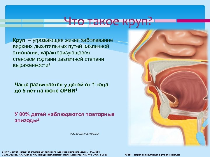 Что такое круп? Круп – угрожающее жизни заболевание верхних дыхательных путей различной этиологии, характеризующееся