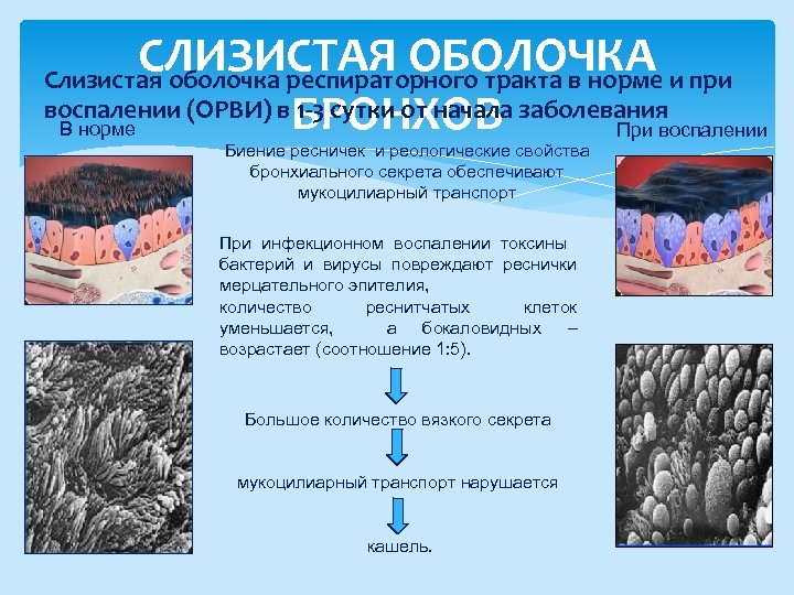 СЛИЗИСТАЯ ОБОЛОЧКА БРОНХОВ В норме При воспалении Слизистая оболочка респираторного тракта в норме и