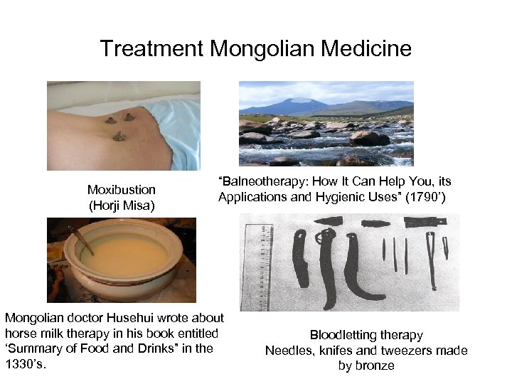Treatment Mongolian Medicine Moxibustion (Horji Misa) “Balneotherapy: How It Can Help You, its Applications