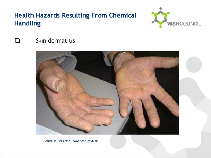 Health Hazards Resulting From Chemical Handling q Skin dermatitis Picture source: http: //www. osh.