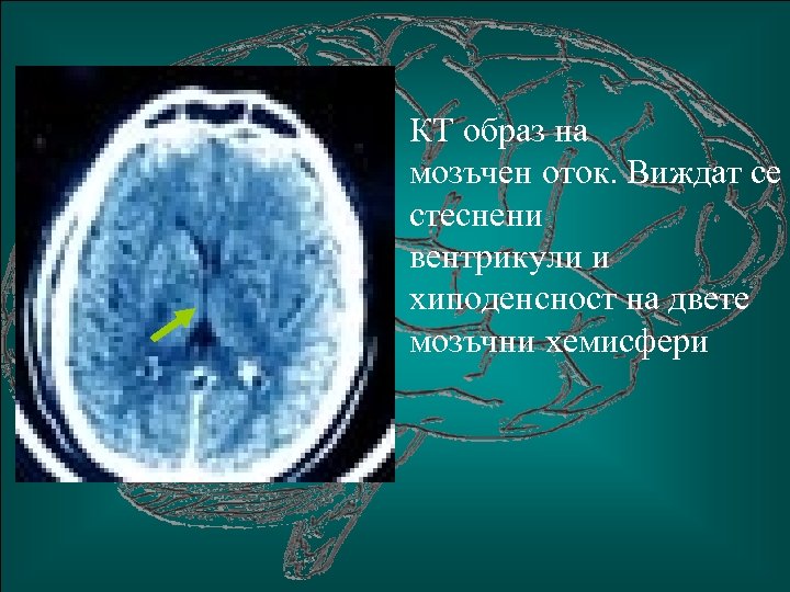 КТ образ на мозъчен оток. Виждат се стеснени вентрикули и хиподенсност на двете мозъчни