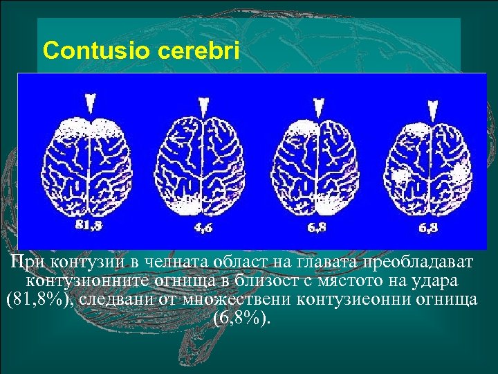 Сontusio cerebri При контузии в челната област на главата преобладават контузионните огнища в близост