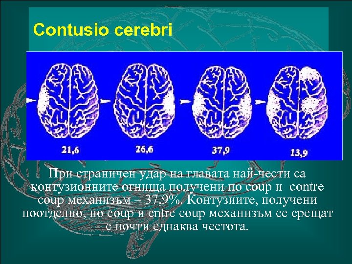 Сontusio cerebri При страничен удар на главата най-чести са контузионните огнища получени по coup