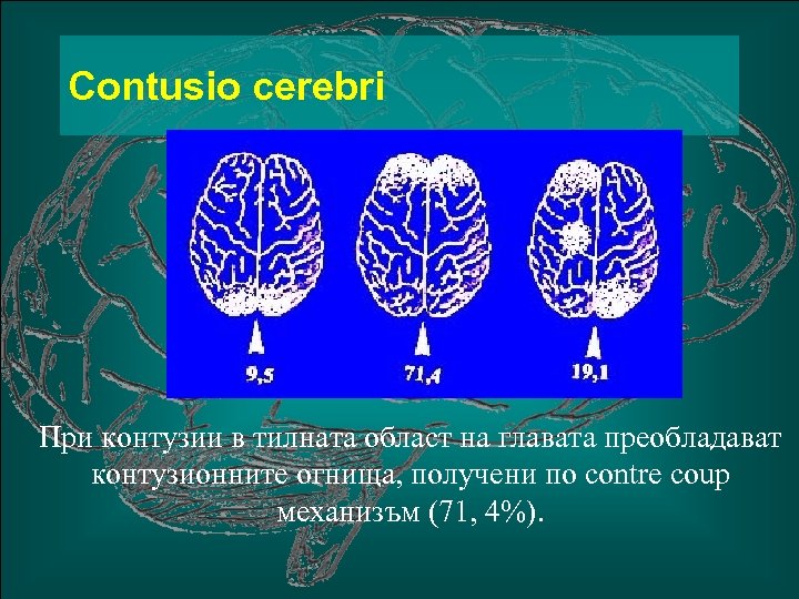 Сontusio cerebri При контузии в тилната област на главата преобладават контузионните огнища, получени по