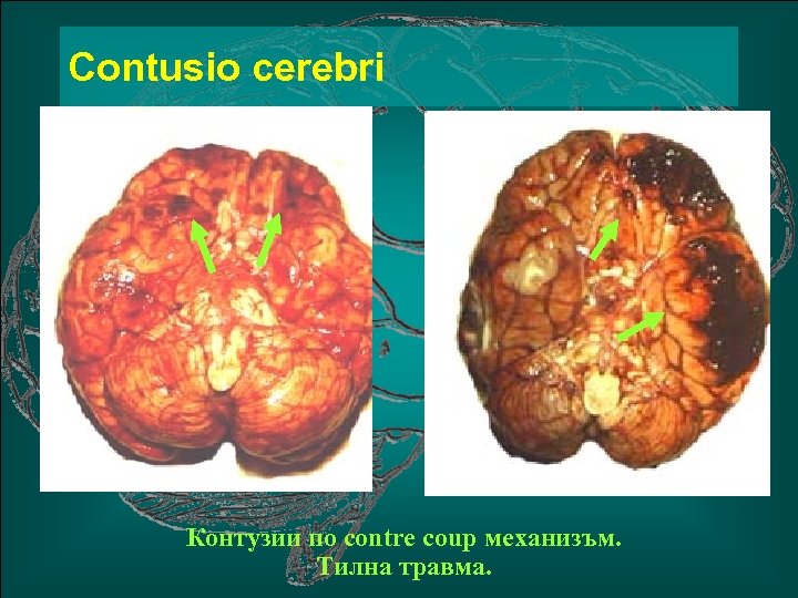 Сontusio cerebri Контузии по contre coup механизъм. Тилна травма. 