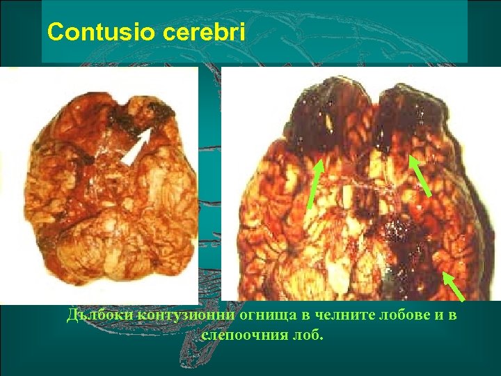 Сontusio cerebri Дълбоки контузионни огнища в челните лобове и в слепоочния лоб. 
