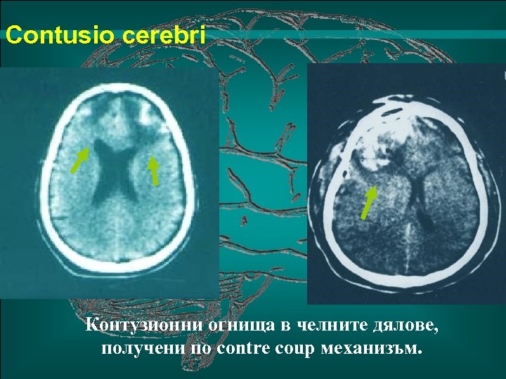 Сontusio cerebri Контузионни огнища в челните дялове, получени по contre coup механизъм. 