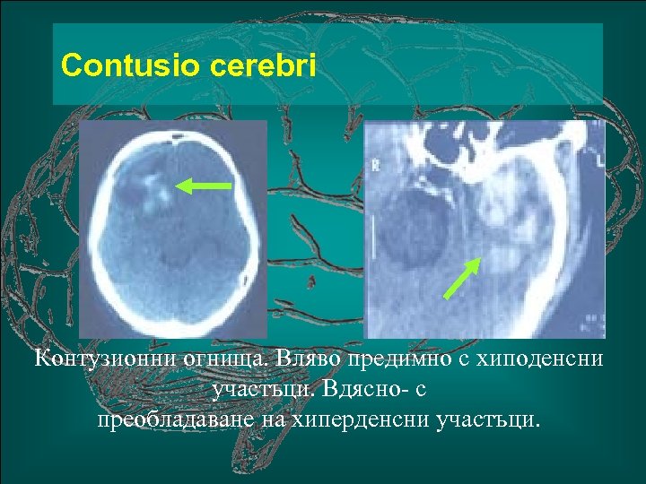 Сontusio cerebri Контузионни огнища. Вляво предимно с хиподенсни участъци. Вдясно- с преобладаване на хиперденсни