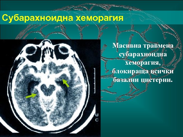 Субарахноидна хеморагия Масивна травмена субарахноидна хеморагия, блокираща всички базални цистерни. 