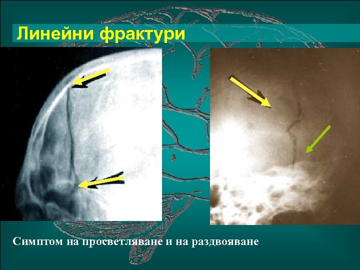 Линейни фрактури Симптом на просветляване и на раздвояване 