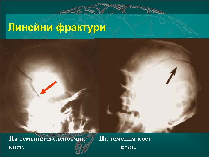 Линейни фрактури На теменна и слепоочна кост. На теменна кост. 