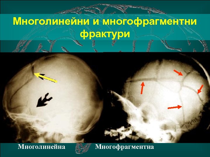 Многолинейни и многофрагментни фрактури Многолинейна Многофрагментна 