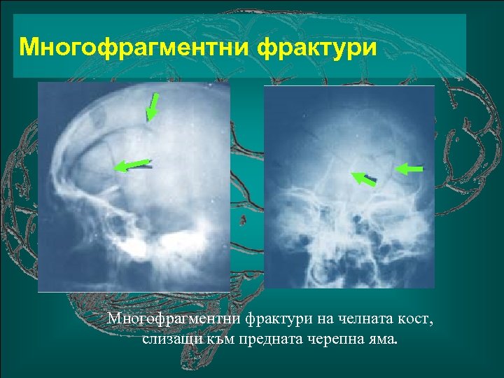 Многофрагментни фрактури на челната кост, слизащи към предната черепна яма. 