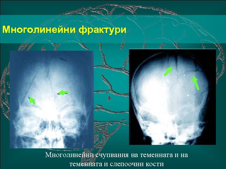Многолинейни фрактури Многолинейни счупвания на теменната и слепоочни кости 