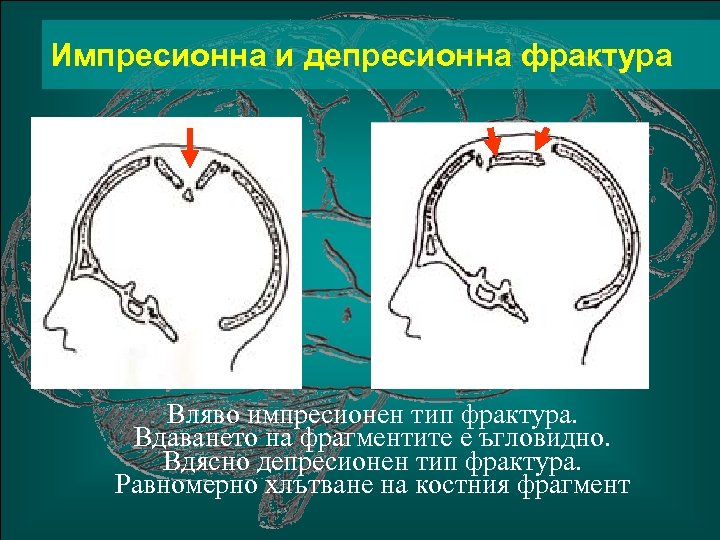 Импресионна и депресионна фрактура Вляво импресионен тип фрактура. Вдаването на фрагментите е ъгловидно. Вдясно