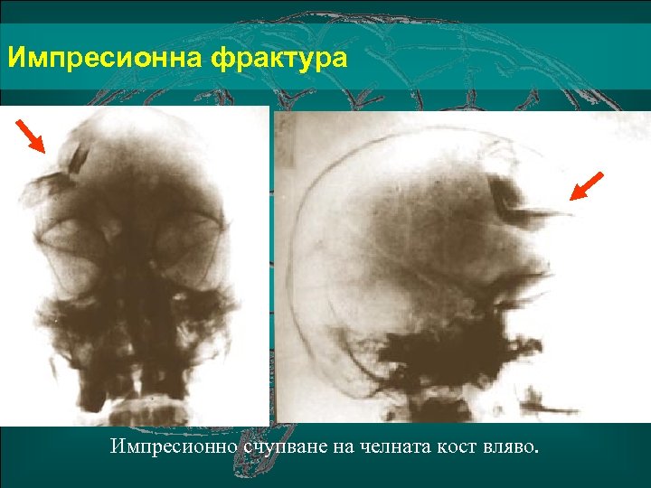 Импресионна фрактура Импресионно счупване на челната кост вляво. 