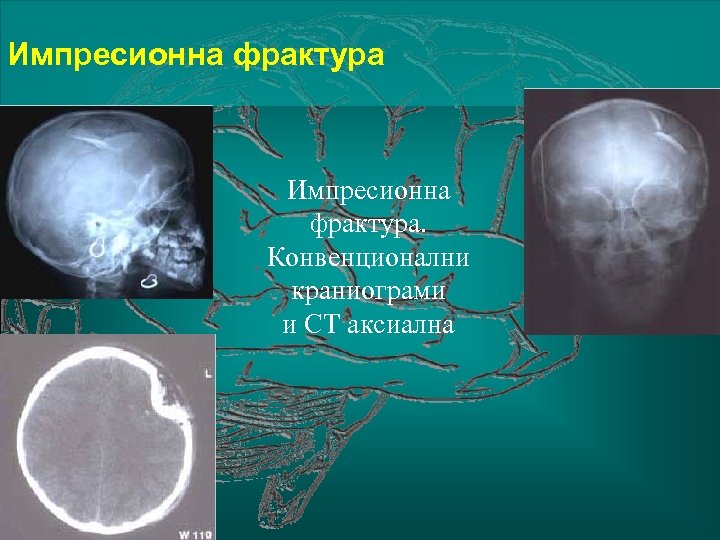Импресионна фрактура. Конвенционални краниограми и СТ аксиална 