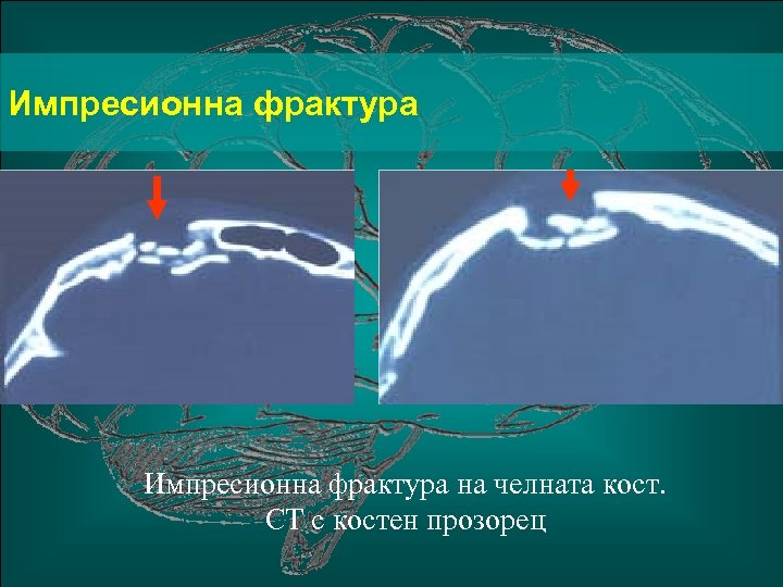 Импресионна фрактура на челната кост. СТ с костен прозорец 