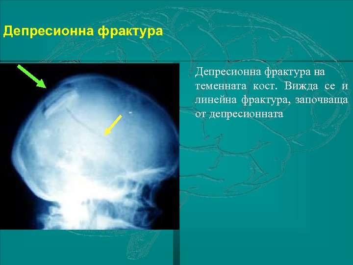 Депресионна фрактура на теменната кост. Вижда се и линейна фрактура, започваща от депресионната 