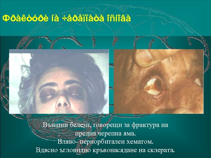 Фðàêòóðè íà ÷åðåïíàòà îñíîâà Външни белези, говорещи за фрактура на предна черепна яма. Вляво-