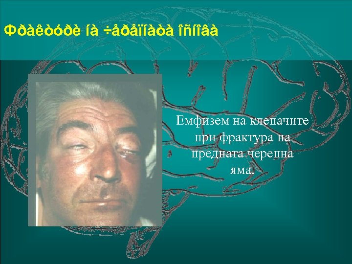 Фðàêòóðè íà ÷åðåïíàòà îñíîâà Емфизем на клепачите при фрактура на предната черепна яма. 