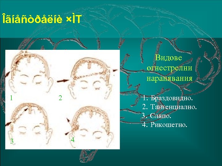 Îãíåñòðåëíè ×ÌТ Видове огнестрелни наранявания 1 3 1. Браздовидно. 2. Тангенциално. 3. Сляпо. 4.