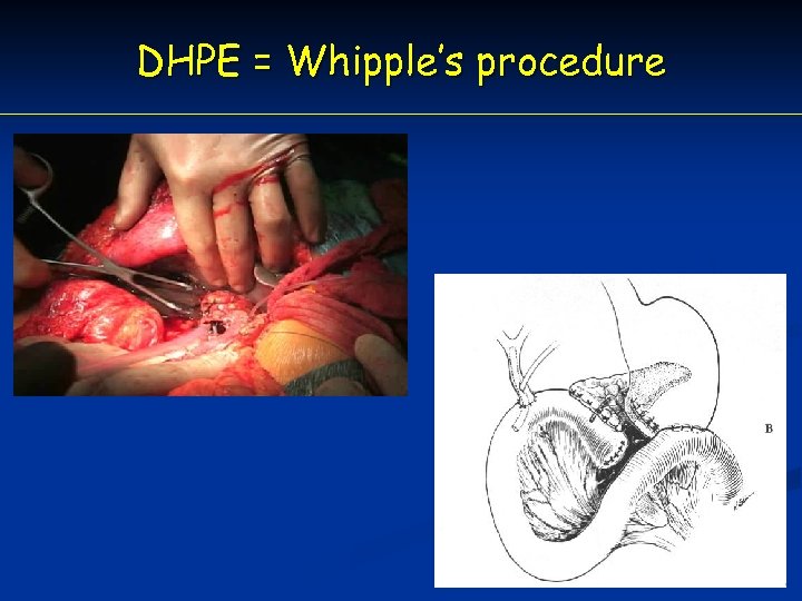 DHPE = Whipple’s procedure 