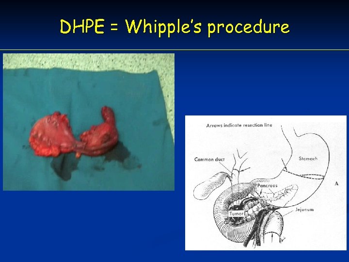 DHPE = Whipple’s procedure 
