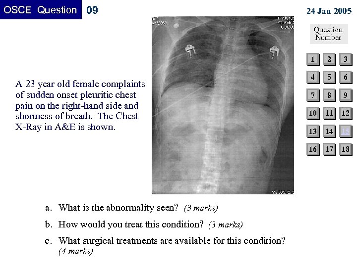 OSCE Question 09 24 Jan 2005 Question Number 1 a. What is the abnormality