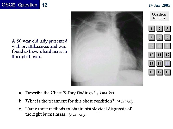 OSCE Question 13 24 Jan 2005 Question Number 1 b. What is the treatment