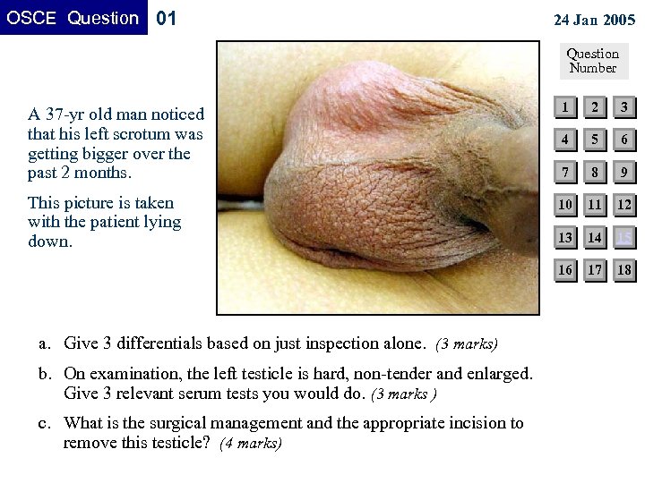 OSCE Question 01 24 Jan 2005 Question Number A 37 -yr old man noticed