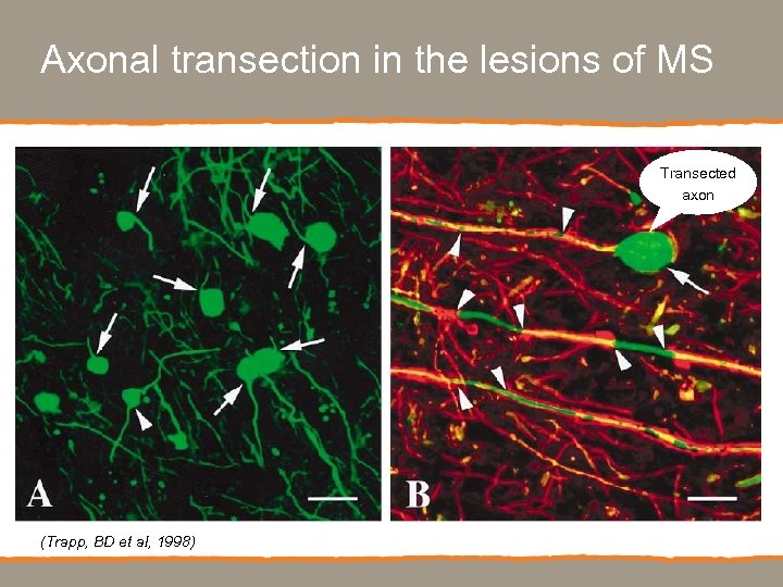 Axonal transection in the lesions of MS Transected axon (Trapp, BD et al, 1998)