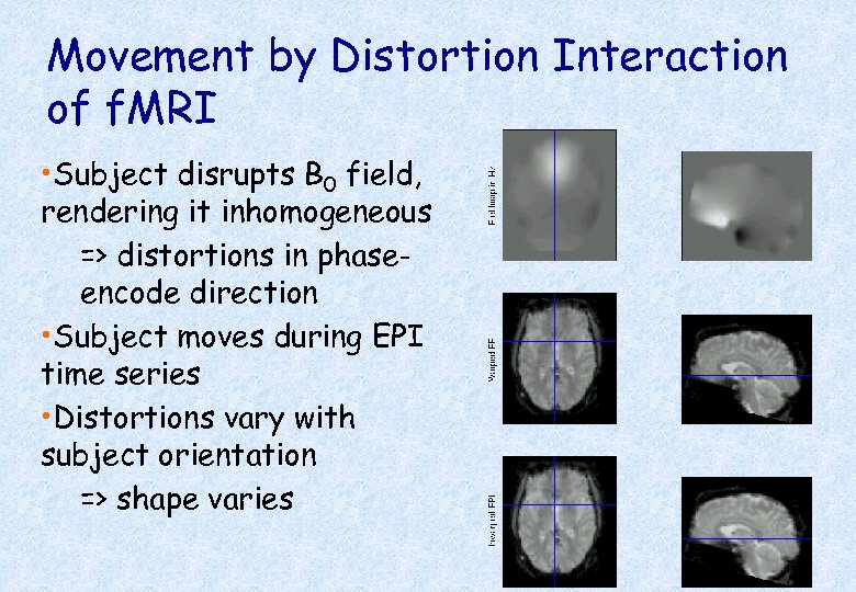 Movement by Distortion Interaction of f. MRI • Subject disrupts B 0 field, rendering