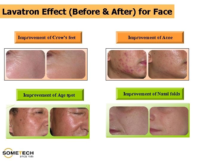 Lavatron Effect (Before & After) for Face Improvement of Crow’s feet Improvement of Age