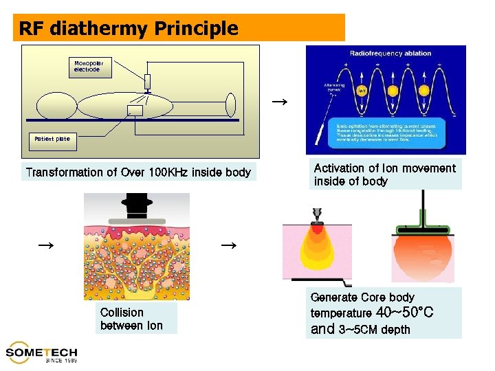 RF diathermy Principle Monopolar electrode → Patient plate Transformation of Over 100 KHz inside