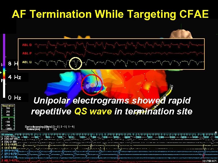 AF Termination While Targeting CFAE 8 Hz 4 Hz 0 Hz Unipolar electrograms showed