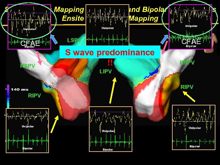 Simultaneous Mapping of Unipolar and Bipolar Electrograms Ensite Noncontact Mapping CFAE RSPV LSPV CFAE