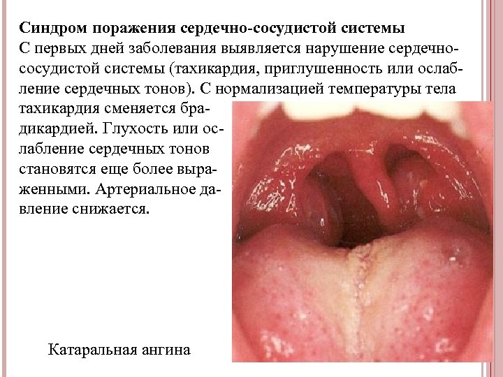Синдром поражения сердечно-сосудистой системы С первых дней заболевания выявляется нарушение сердечнососудистой системы (тахикардия, приглушенность