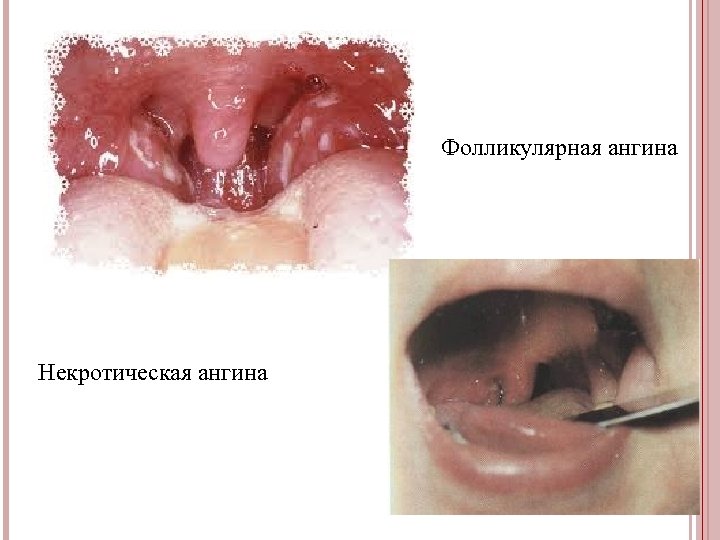 Фолликулярная ангина Некротическая ангина 