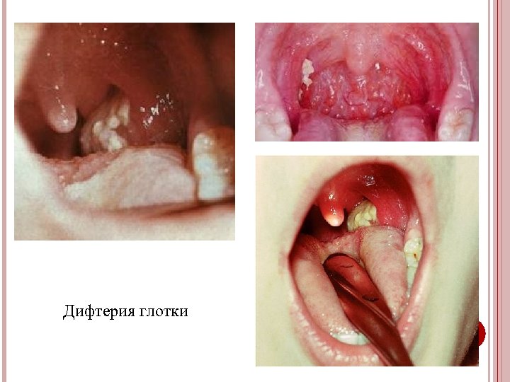 Дифтерия глотки 