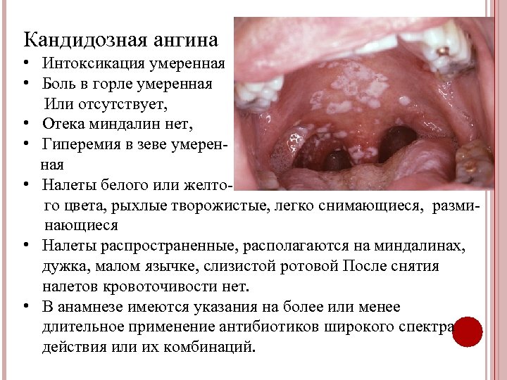 Кандидозная ангина • Интоксикация умеренная • Боль в горле умеренная Или отсутствует, • Отека