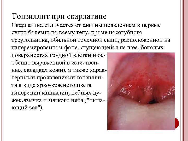 Тонзиллит при скарлатине Скарлатина отличается от ангины появлением в первые сутки болезни по всему