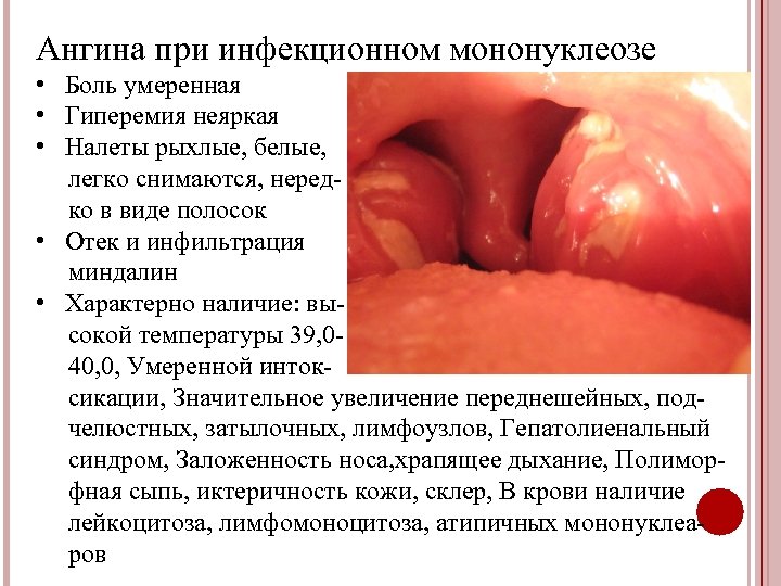 Ангина при инфекционном мононуклеозе • Боль умеренная • Гиперемия неяркая • Налеты рыхлые, белые,