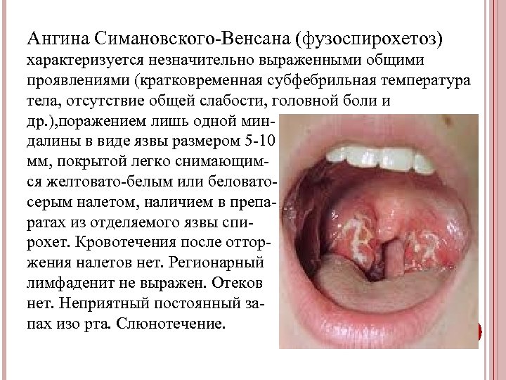 Ангина Симановского-Венсана (фузоспирохетоз) характеризуется незначительно выраженными общими проявлениями (кратковременная субфебрильная температура тела, отсутствие общей