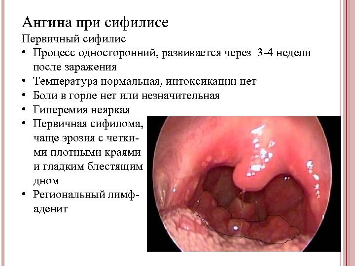 Ангина при сифилисе Первичный сифилис • Процесс односторонний, развивается через 3 -4 недели после