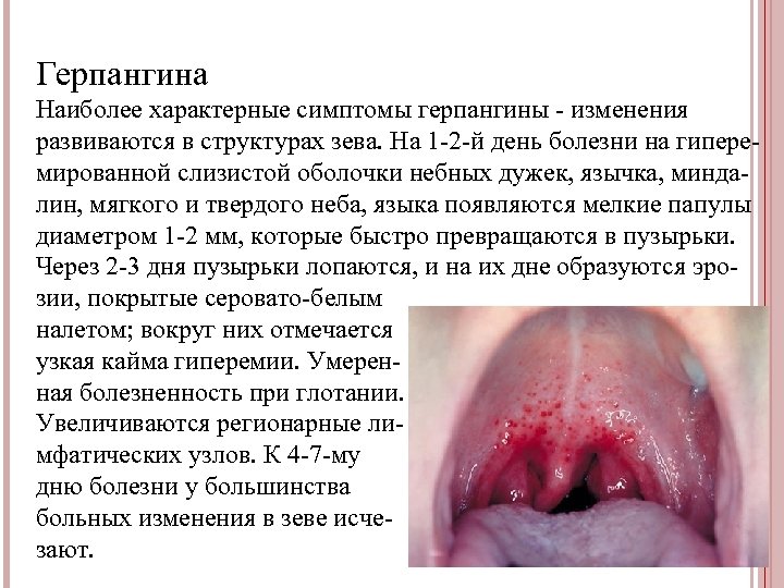 Герпангина Наиболее характерные симптомы герпангины - изменения развиваются в структурах зева. На 1 -2