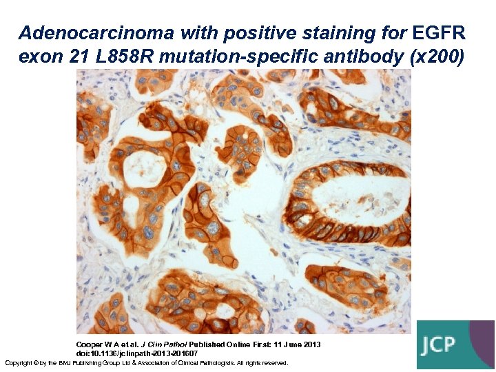 Adenocarcinoma with positive staining for EGFR exon 21 L 858 R mutation-specific antibody (x